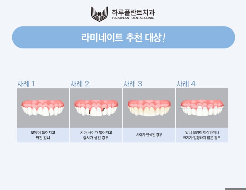 강남 하루플란트치과 라미네이트 후회하지않으려면 사진 4