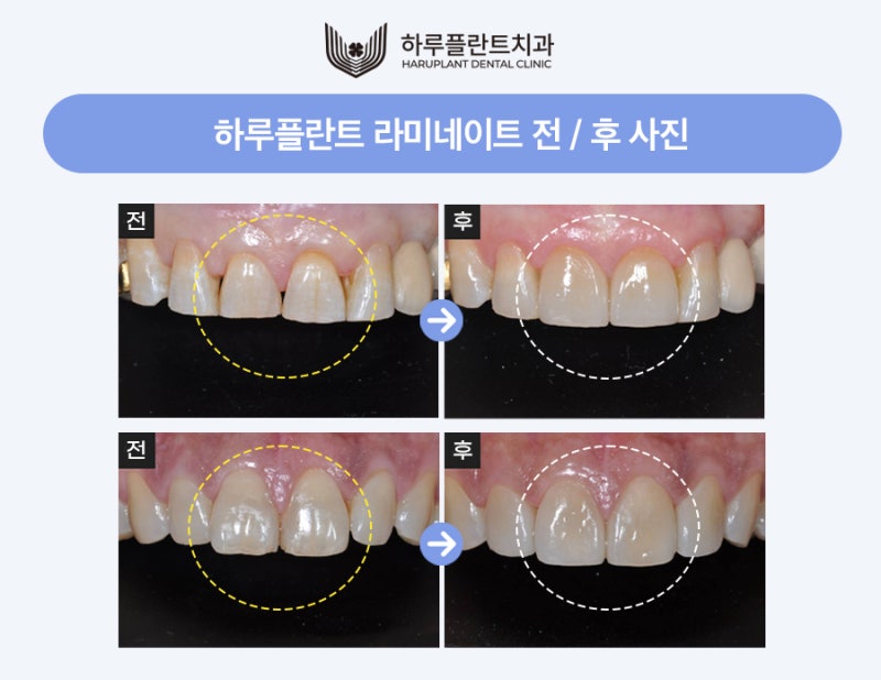 강남 하루플란트치과 라미네이트 후회하지않으려면 사진 6