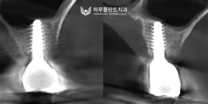 강남역 하루플란트치과 임플란트 무절개 상악동 거상술 진행 케이스 사진 10