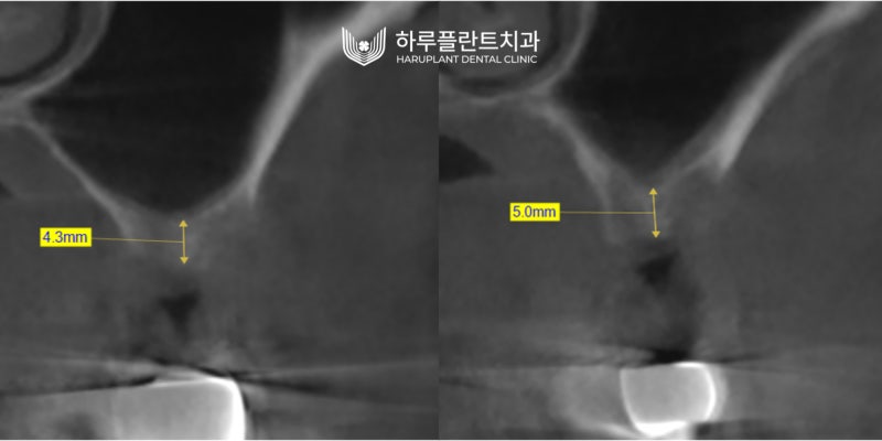 강남역 하루플란트치과 임플란트 무절개 상악동 거상술 진행 케이스 사진 7