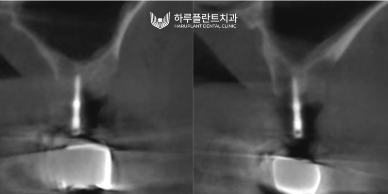 강남역 하루플란트치과 임플란트 무절개 상악동 거상술 진행 케이스 사진 8