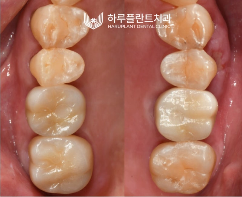 강남역 하루플란트치과 임플란트 무절개 상악동 거상술 진행 케이스 사진 11