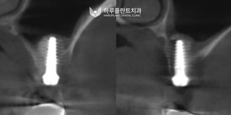 강남역 하루플란트치과 임플란트 무절개 상악동 거상술 진행 케이스 사진 9