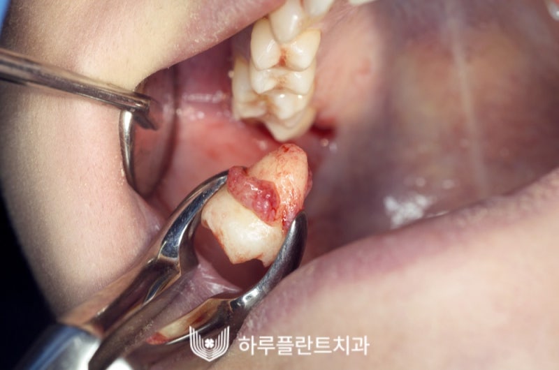 강남 하루플란트치과 사랑니발치, 사랑니 꼭 뽑아야할까요?