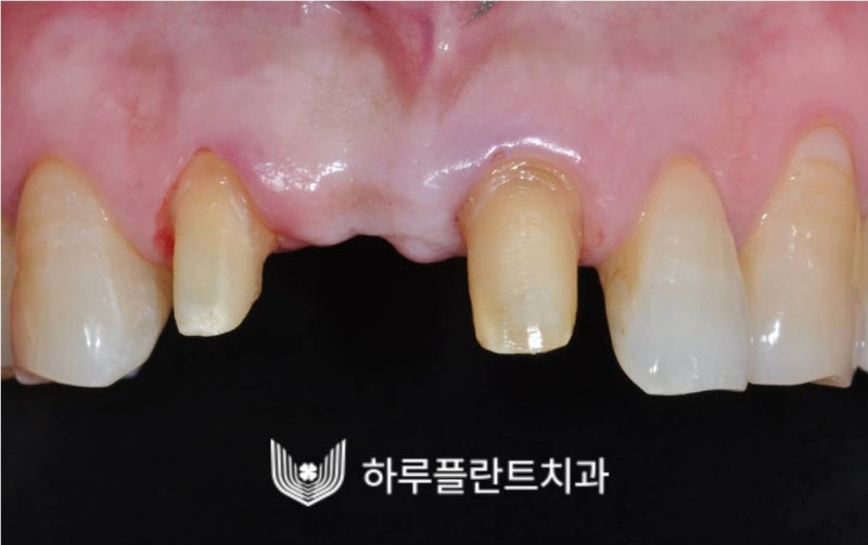 강남역 하루플란트치과 앞니 임플란트 후기 전후차이 사진 10