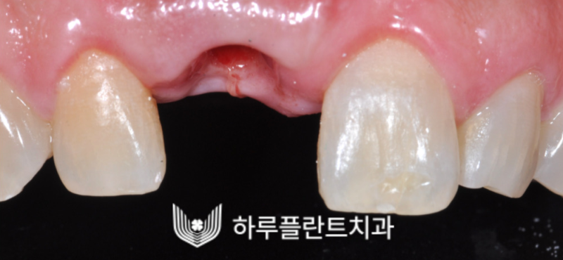 강남역 하루플란트치과 앞니 임플란트 후기 전후차이 사진 3