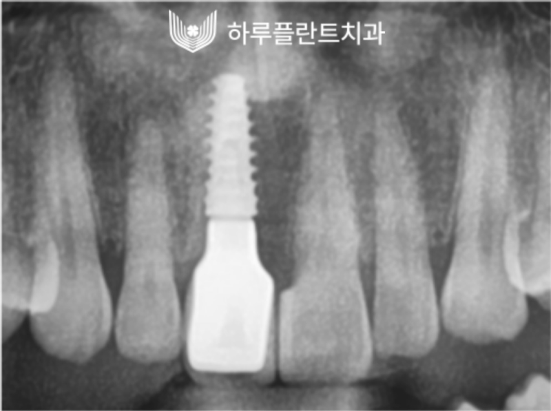 강남역 하루플란트치과 앞니 임플란트 후기 전후차이 사진 5