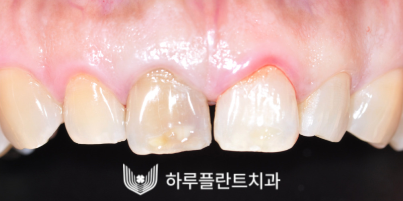 강남역 하루플란트치과 앞니 임플란트 후기 전후차이 사진 2