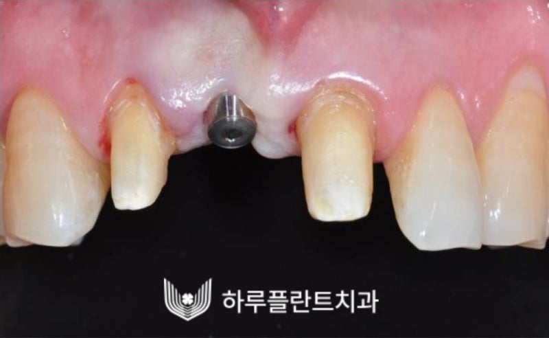강남역 하루플란트치과 앞니 임플란트 후기 전후차이 사진 11