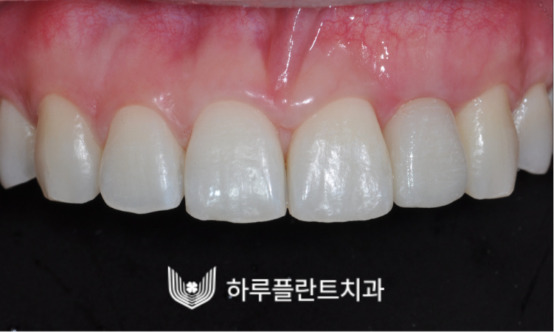 강남역 하루플란트치과 앞니 임플란트 후기 전후차이 사진 7