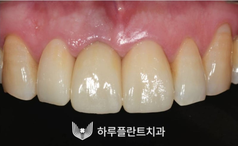 강남역 하루플란트치과 앞니 임플란트 후기 전후차이 사진 13