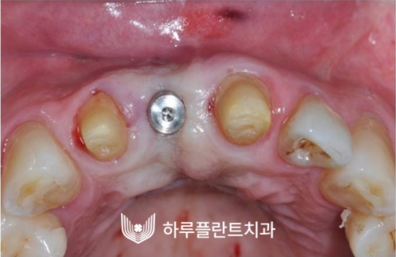 강남역 하루플란트치과 앞니 임플란트 후기 전후차이 사진 12