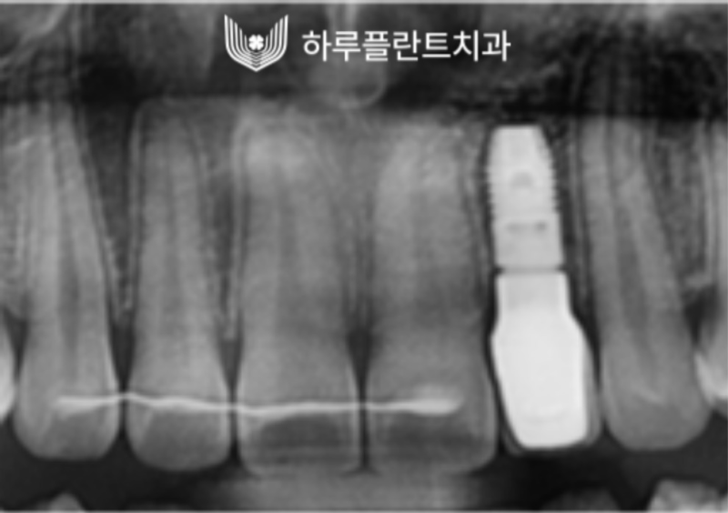 강남역 하루플란트치과 앞니 임플란트 후기 전후차이 사진 9