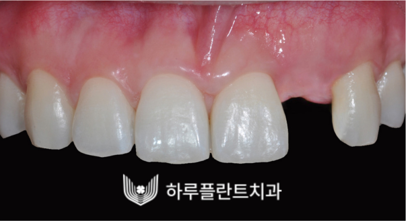 강남역 하루플란트치과 앞니 임플란트 후기 전후차이