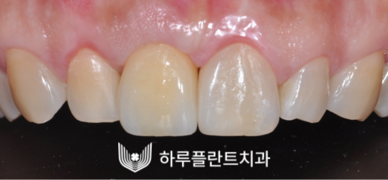 강남역 하루플란트치과 앞니 임플란트 후기 전후차이 사진 4