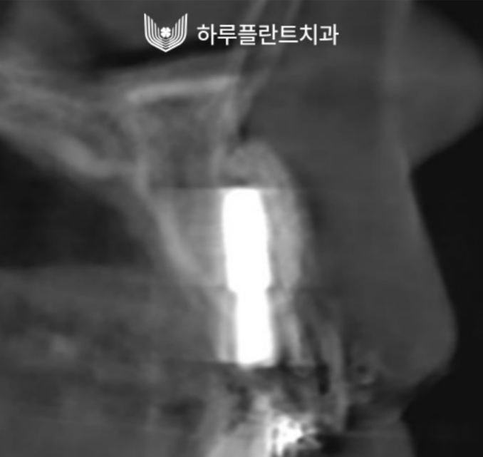 강남역 하루플란트치과 앞니 임플란트 후기 전후차이 사진 8