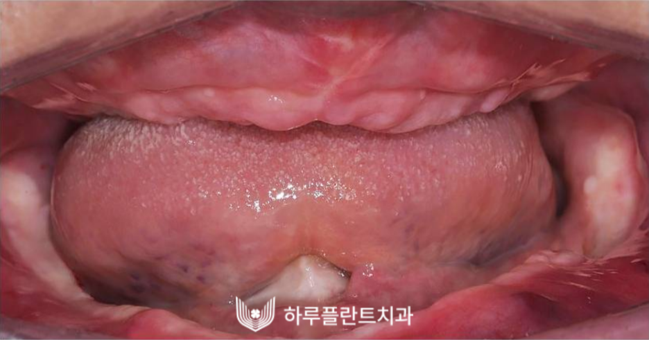 하루플란트치과 변성만 대표원장 타치과 임플란트 불가판정 성공사례 사진 7
