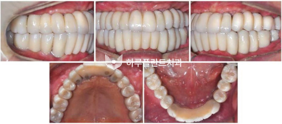하루플란트치과 변성만 대표원장 타치과 임플란트 불가판정 성공사례 사진 5