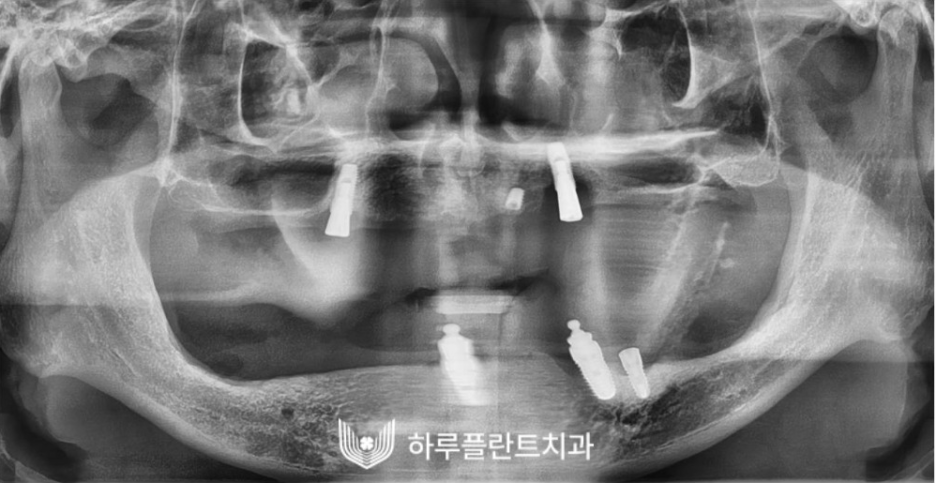하루플란트치과 변성만 대표원장 타치과 임플란트 불가판정 성공사례 사진 3