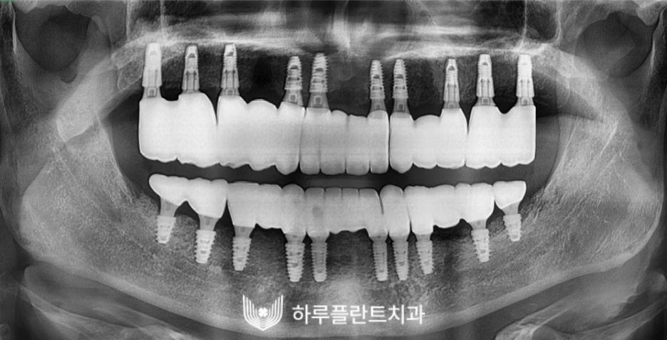 하루플란트치과 변성만 대표원장 타치과 임플란트 불가판정 성공사례 사진 8