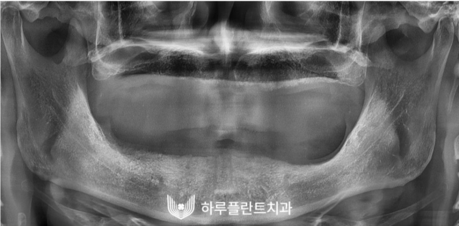 하루플란트치과 변성만 대표원장 타치과 임플란트 불가판정 성공사례 사진 6