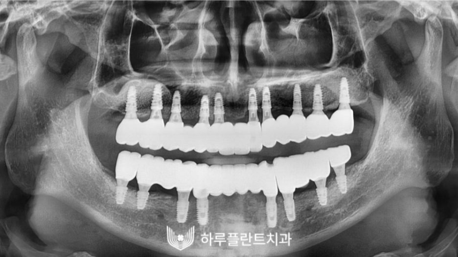 하루플란트치과 변성만 대표원장 타치과 임플란트 불가판정 성공사례