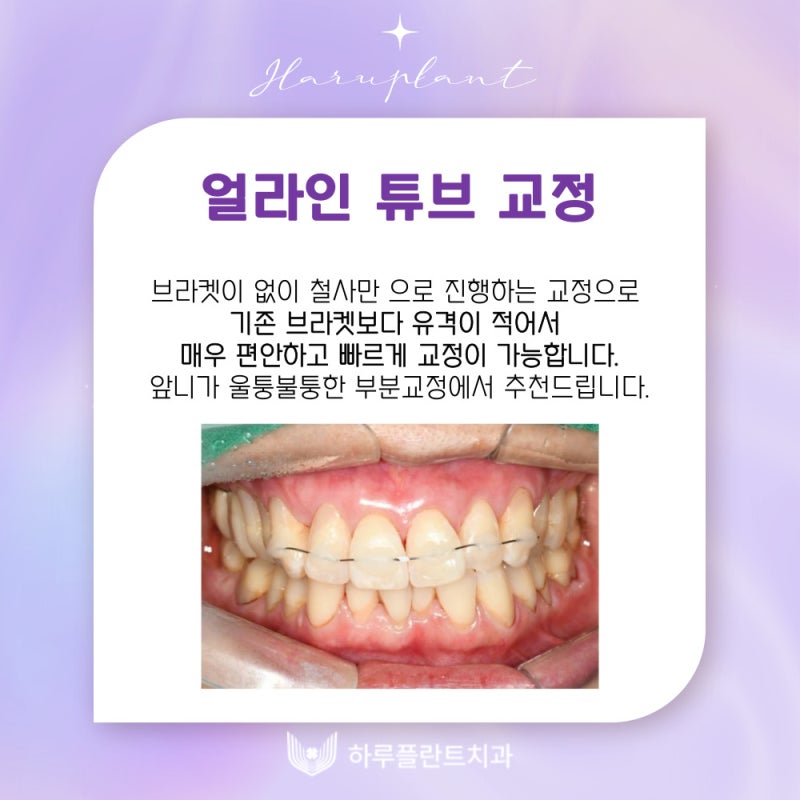 강남역치과 하루플란트치과 치아교정 개인별 맞춤 교정으로 사진 18