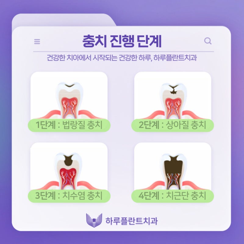 강남역치과 하루플란트치과 충치치료 미루고있다면 사진 6