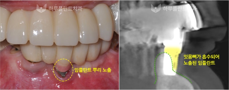 강남역치과 하루플란트치과 임플란트 주위염 원인부터 예방법까지