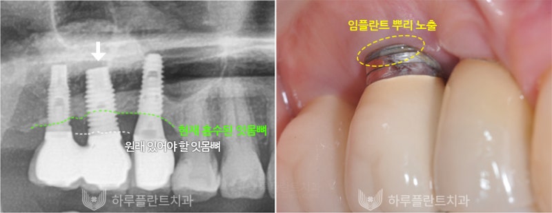 강남역치과 하루플란트치과 임플란트 주위염 원인부터 예방법까지 사진 3