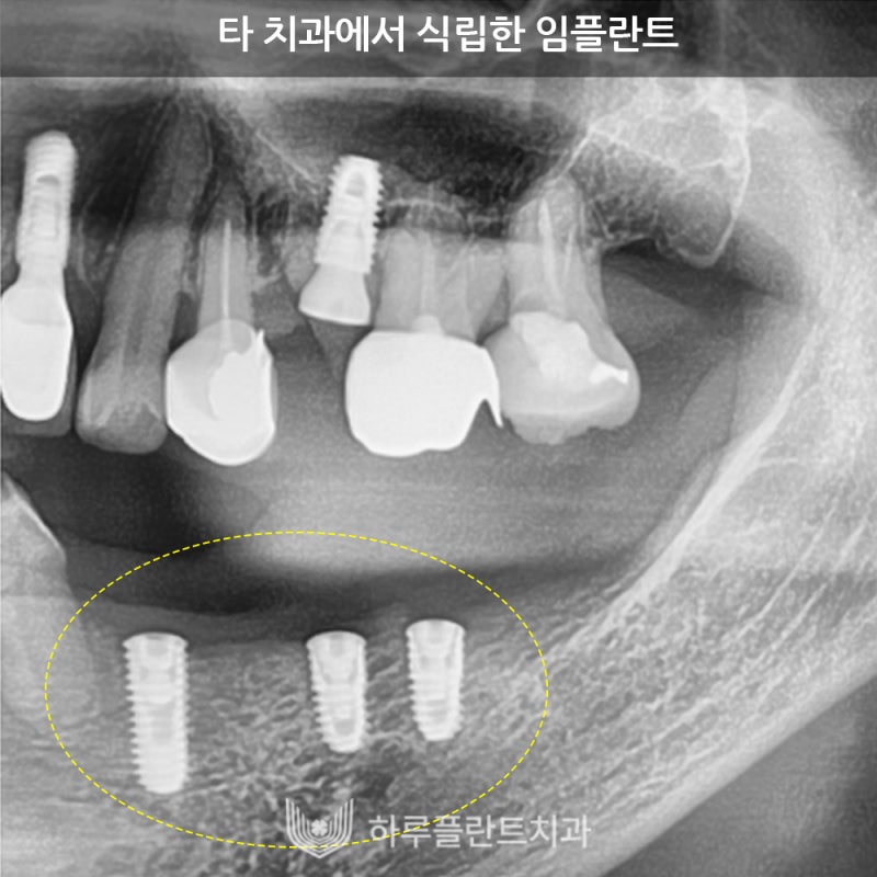 강남역치과 하루플란트치과 임플란트 주위염 원인부터 예방법까지 사진 5