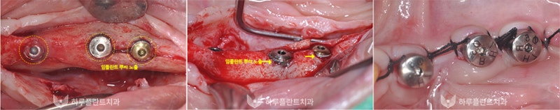강남역치과 하루플란트치과 임플란트 주위염 원인부터 예방법까지 사진 6