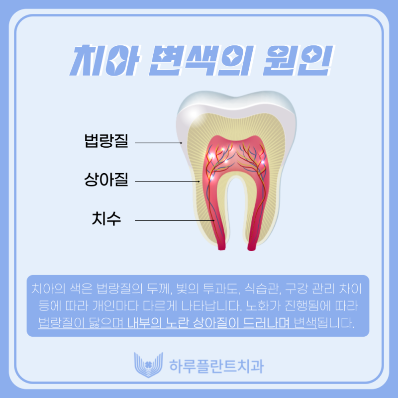 강남치과 하루플란트치과 치아미백 고민중이라면 사진 2