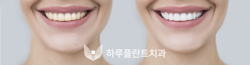 강남치과 하루플란트치과 치아미백 고민중이라면 사진 4