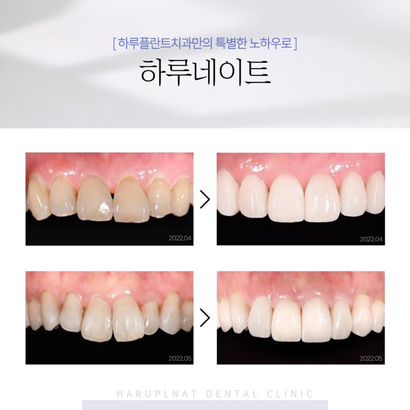 강남 하루플란트치과 라미네이트, 치아 삭제가 걱정된다면 사진 5