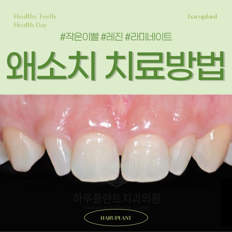 강남역 하루플란트치과 작은이빨 왜소치 치료방법은?