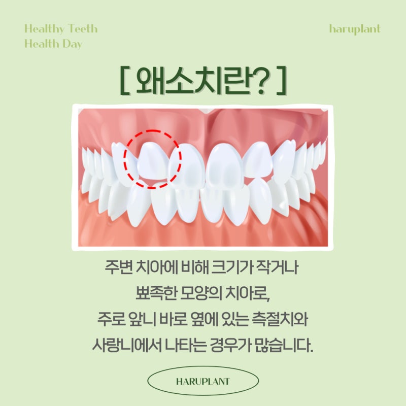 강남역 하루플란트치과 작은이빨 왜소치 치료방법은?