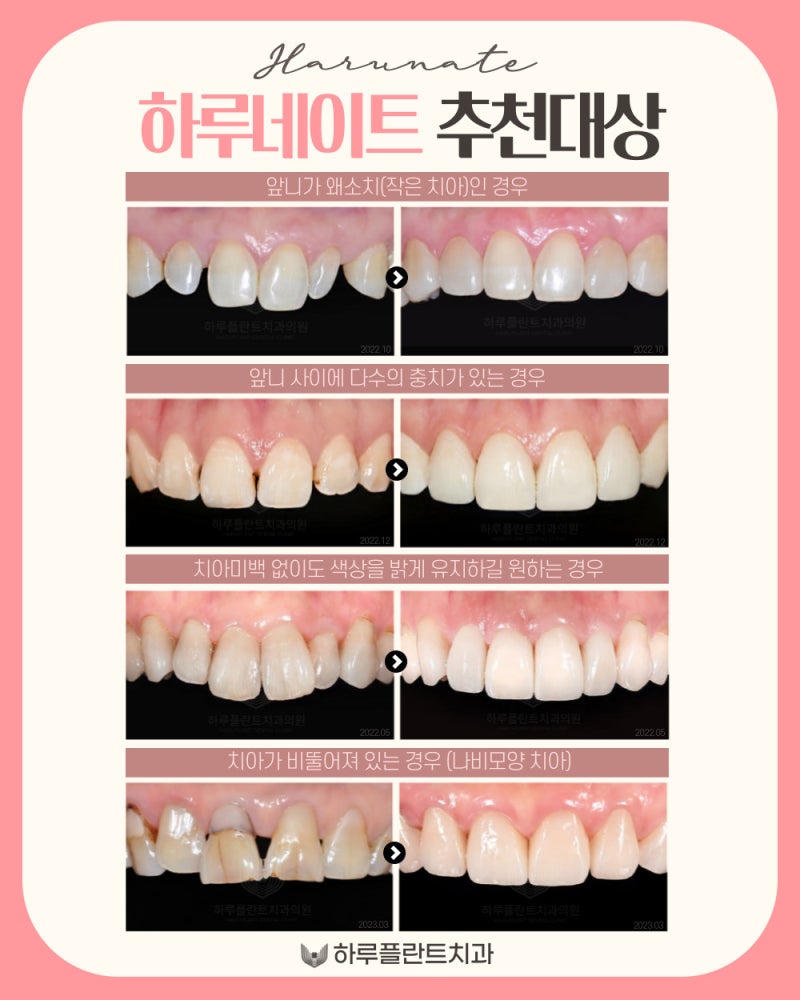 강남역 하루플란트치과 당일 완성 라미네이트 사진 7