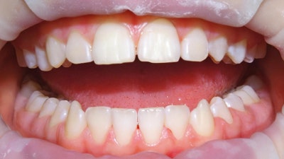 강남역스케일링 통증,시림 없는 프리미엄 에어플로우 스케일링 사진 8