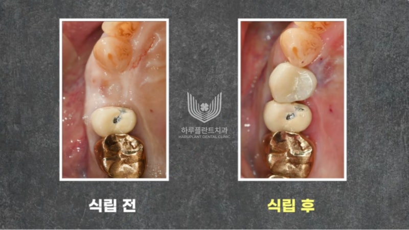 강남구 당일 임플란트 성공의 비결은? 사진 10