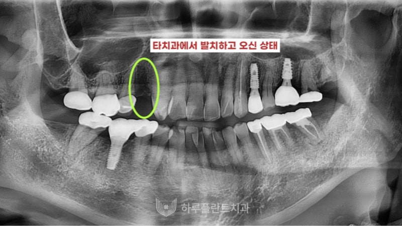 강남구 당일 임플란트 성공의 비결은? 사진 5