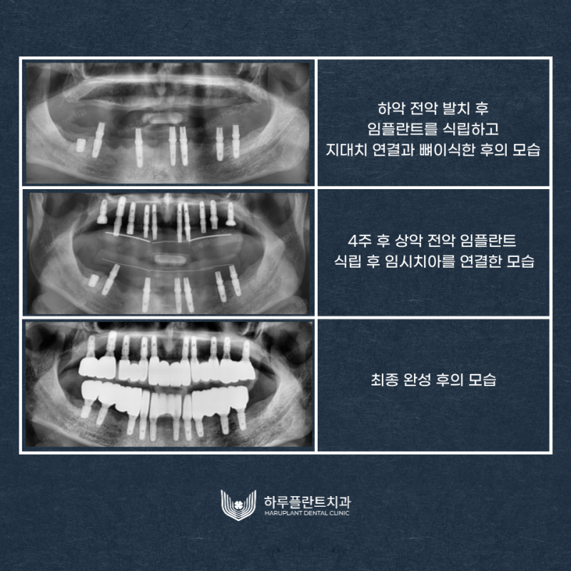 강남역치과 무치악 임플란트 알아보고 있다면 사진 5