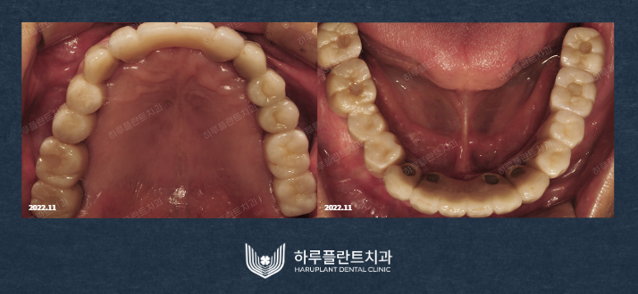 강남역치과 무치악 임플란트 알아보고 있다면 사진 6