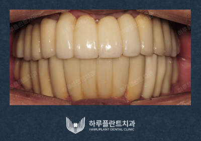 강남역치과 무치악 임플란트 알아보고 있다면 사진 7