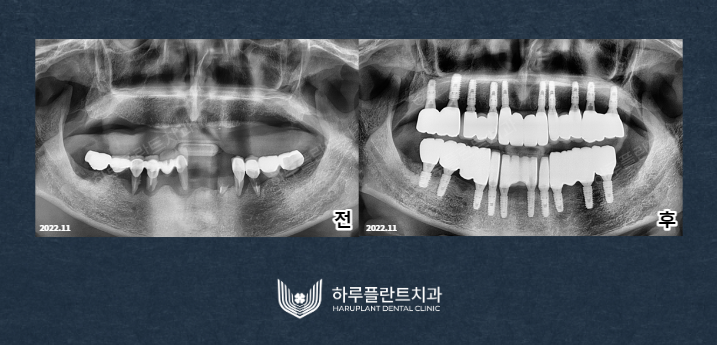 강남역치과 무치악 임플란트 알아보고 있다면