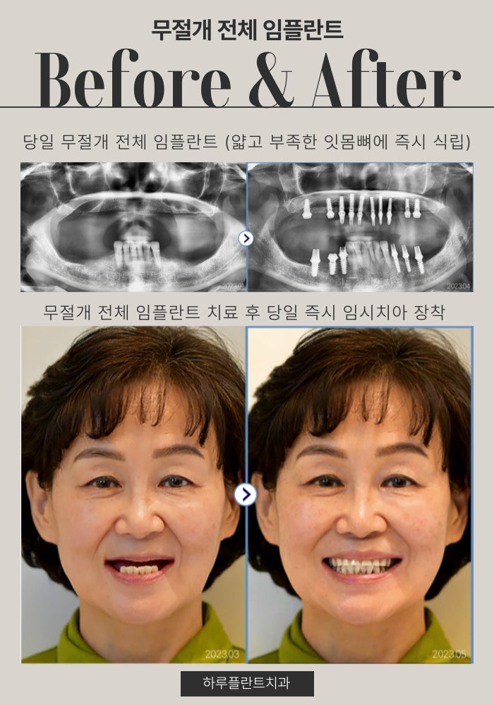 강남구전체임플란트 잘하는곳 이것만은 꼭 확인하세요 사진 5