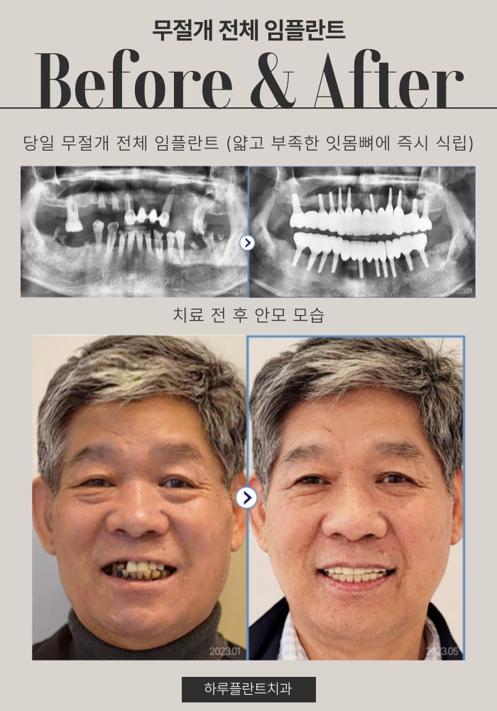 강남구전체임플란트 잘하는곳 이것만은 꼭 확인하세요 사진 6