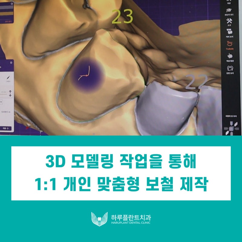 서초동치과 원내기공실이 있는 치과가 좋은이유 사진 5