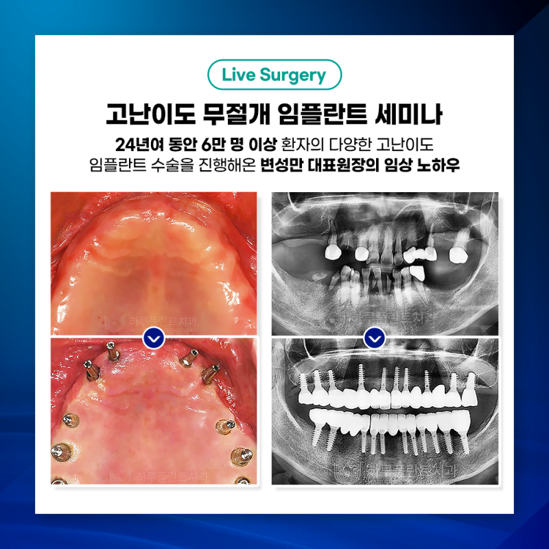 하루플란트치과 변성만 대표원장 무절개 임플란트 세미나 사진 6