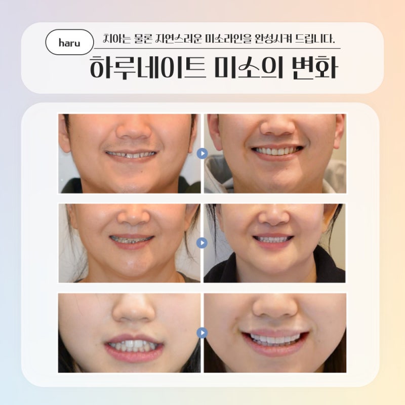 강남역치과 무삭제 라미네이트 총정리(부작용,치료기간,비용) - 하루플란트치과 사진 9